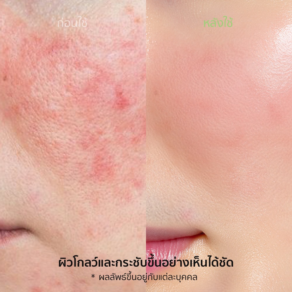 NUKIT Pore Reset Peeling Ampoule ผลัดผิว กระชับรูขุมขน คุมมัน สิวเสี้ยน